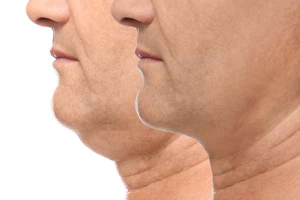 HIFU - Breakthrough in Anti - ageing 2 hifu results Nazeing