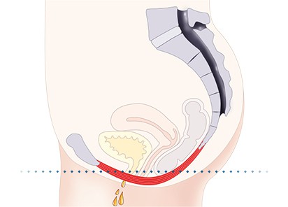 Pelvic-Floor Muscle Repair 5 Pelvic floor muscles Nazeing