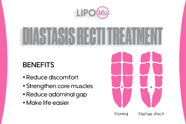 Revolutionising Muscle Repair: The Power of LIPO360 Body Sculpt Post-Injury 5 diastasis recti treatment Nazeing