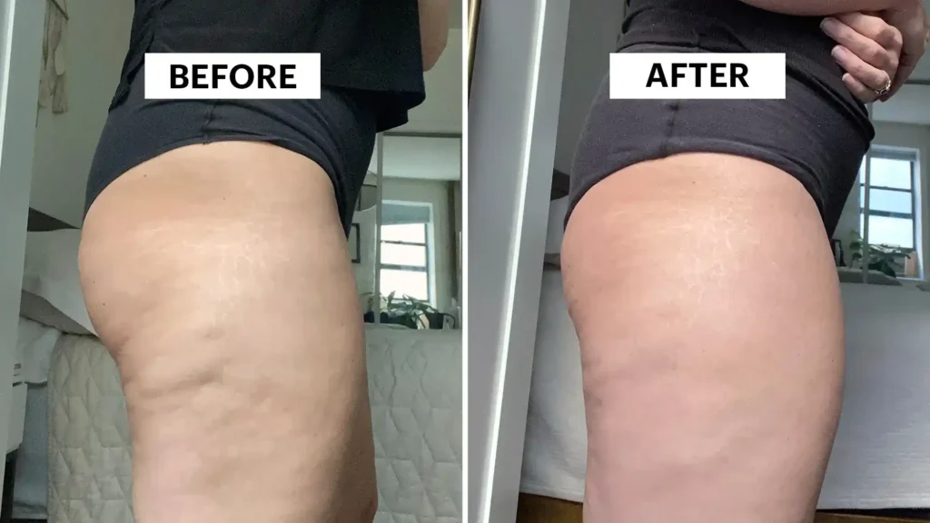 Sculpting Your Bum: Can Toning Exercises Really Reduce Cellulite? 1 Do Toning Exercise Nazeing Really Tackle Cellulite?
