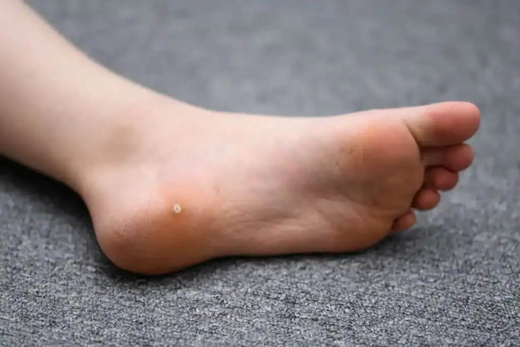 Cryotherapy For Warts And Also Verrucas 2 Image of verruca on the bottom of the foot that able to be treated with Cryotherapy Nazeing