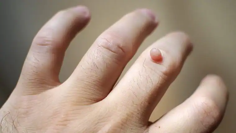 Cryotherapy For Warts And Also Verrucas 1 Image of blemish that Cryotherapy Nazeing can remove with Lipo 360.