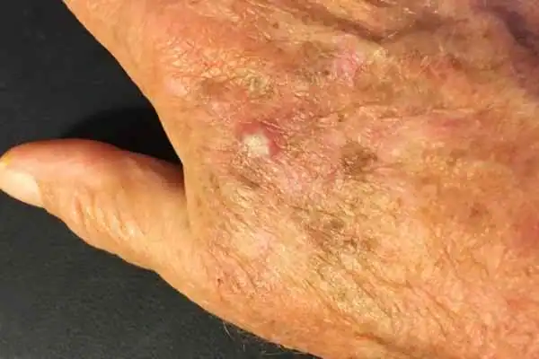 Cryopen For Actinic Keratoses 1 Image of Actinic keratoses Nazeing on a person hand