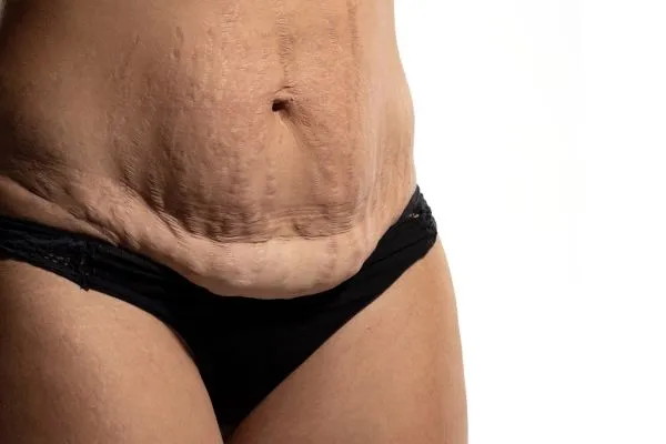 The Science of Skin Tightening 1 The science behind skin tightening Nazeing picture of a woman's sagging skin on the stomach